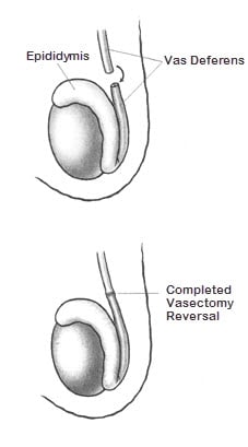 Timeframe for Getting Pregnant After a Vasectomy Reversal
